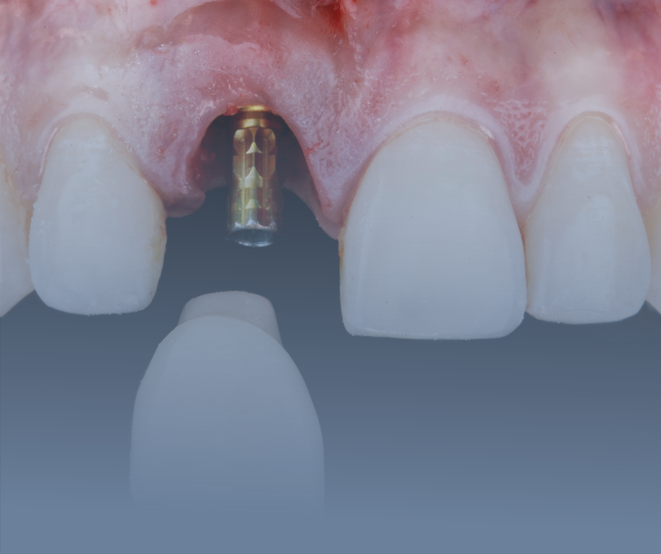 Implantes